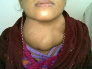 Goiter or swollen Thyroid gland.